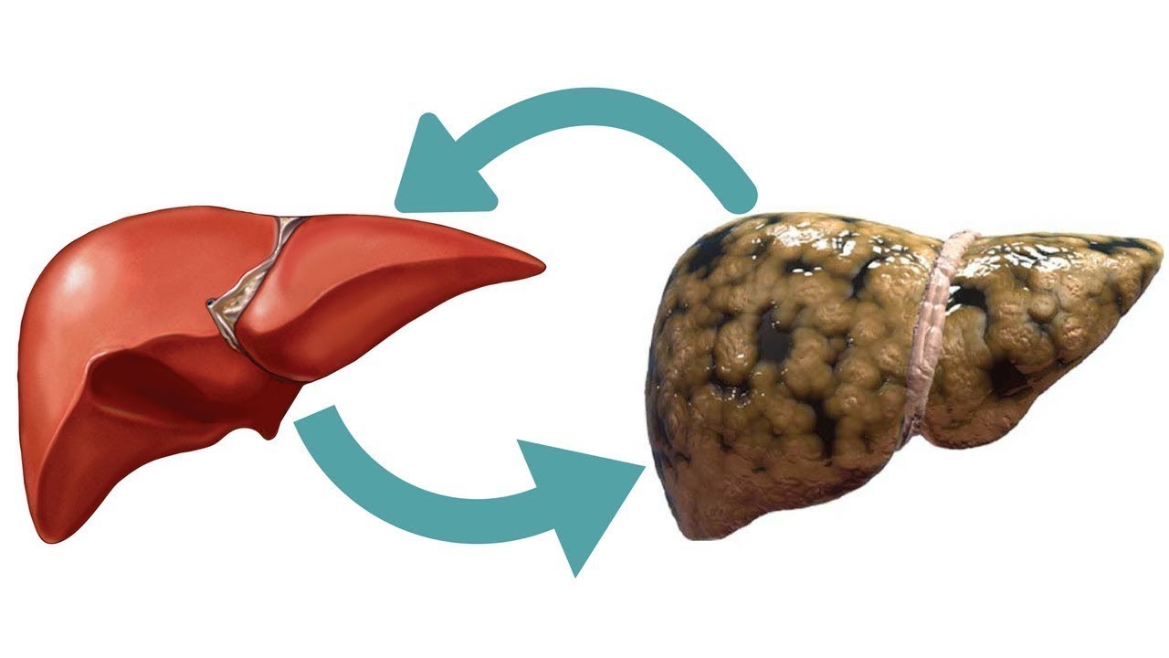 Keeping Liver Healthy: Understanding and Preventing Fatty Liver