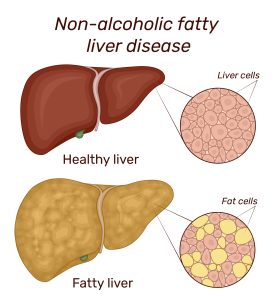 Fatty Liver