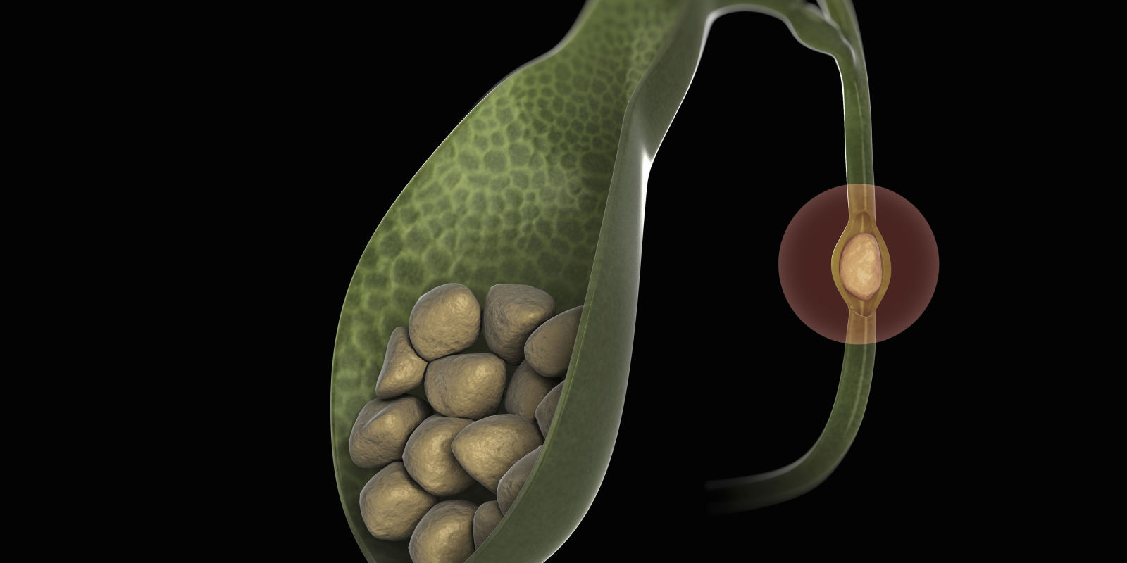 Gallstones Made Simple: A Guide to Causes, Symptoms, and Solutions