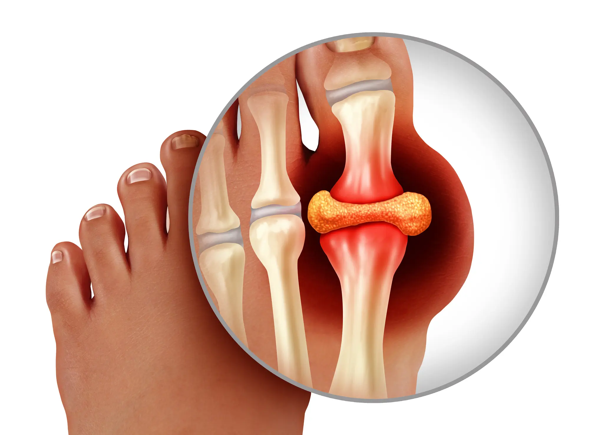 Gout Flare-Ups: What Triggers Them and How to Find Relief