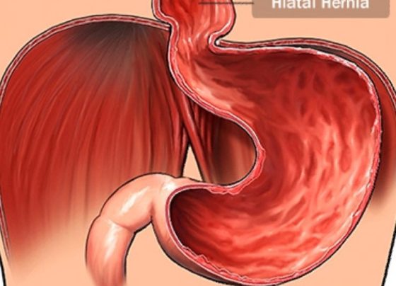 Hiatal Hernia