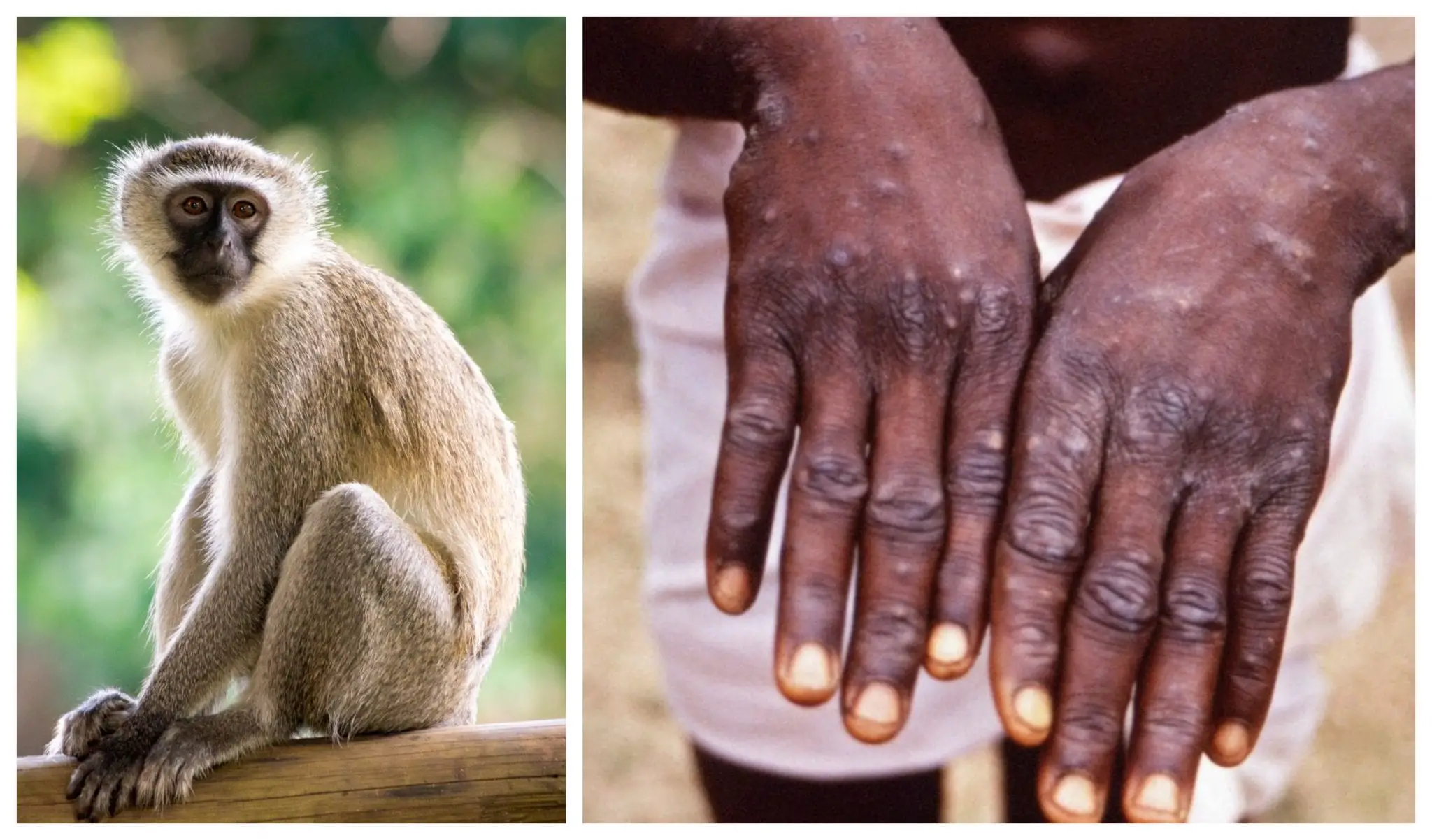 Keeping Kids Safe: What Parents Must Know About Monkeypox