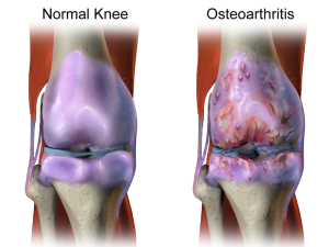 Knee Arthritis Treatments