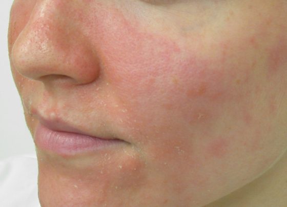 Perioral Dermatitis