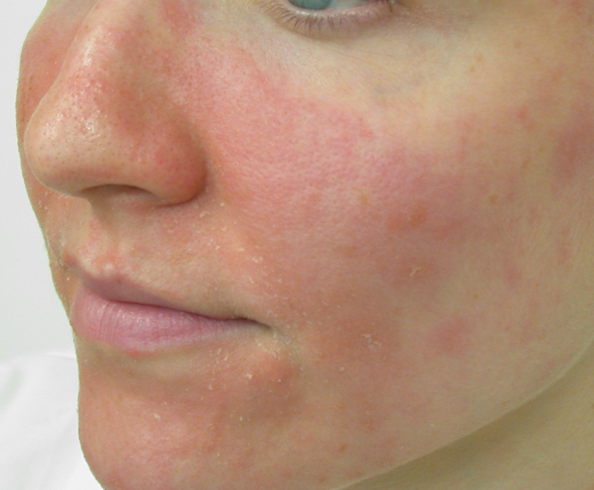 Perioral Dermatitis Explained: Signs, How to Treat It