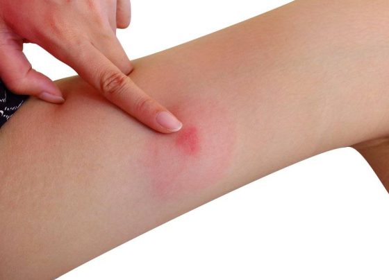 Signs That Cellulitis