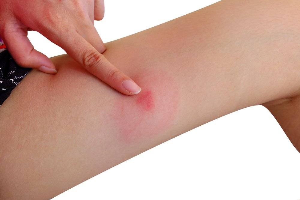 What are The Signs That Cellulitis is Healing?