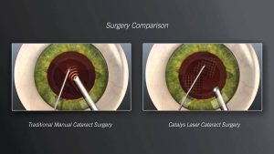 Cataract Treatment