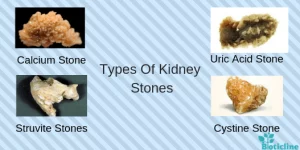 Kidney Stone