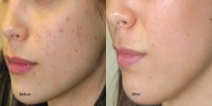  Acne & Clogged Pores: Chemical peels, advance chemical peel treatment, chemical peel treatment for pigmentation 