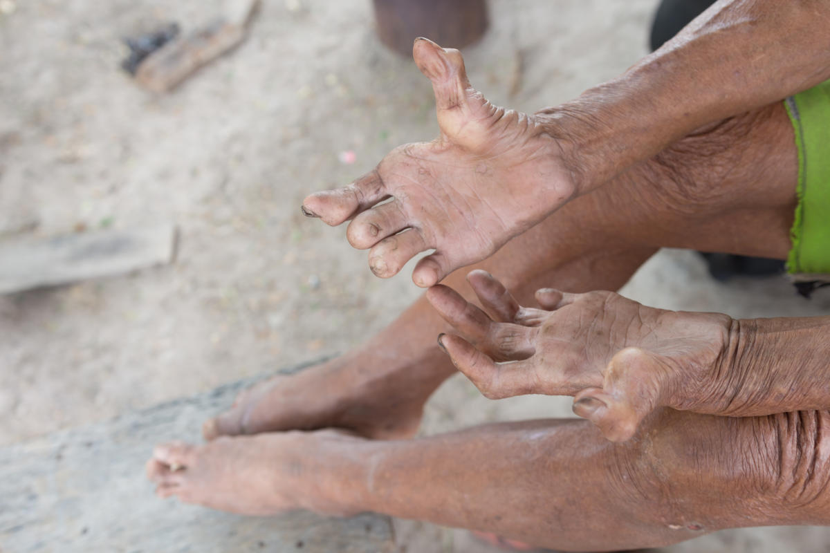 Florida’s Leprosy Dilemma: Evaluating Risks and Preparedness