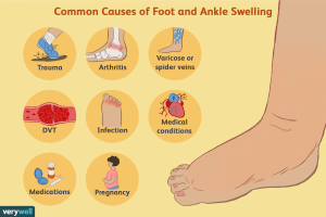 Ankle Swelling