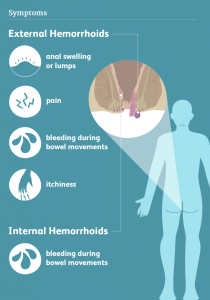 Hemorrhoids 