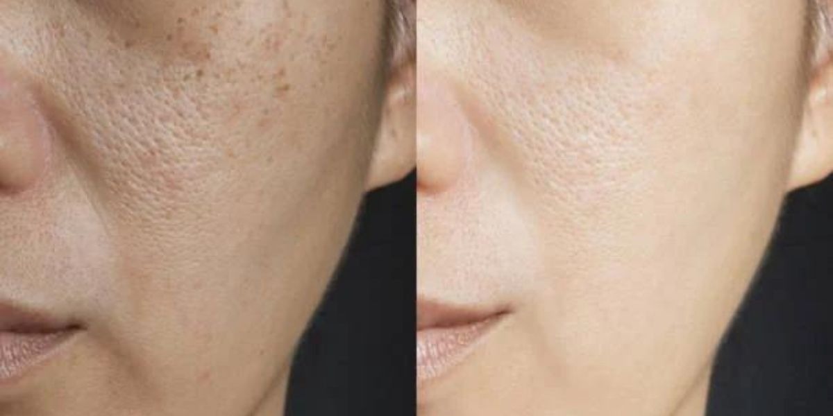 advanced Chemical Peel Treatment