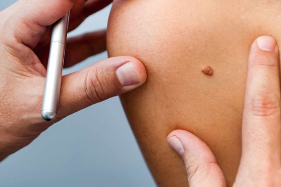 New Technologies in Skin Cancer Screening: What’s Next?