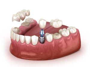 Dental Implants