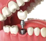 dental implant