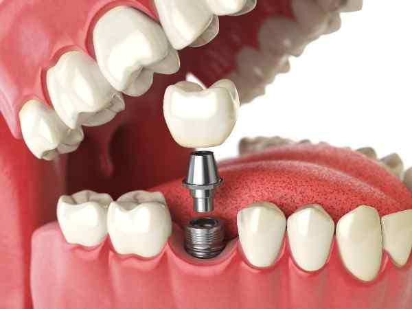 Bone Grafts: A Key Factor in Implant Stability