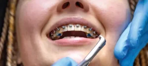 Orthodontic